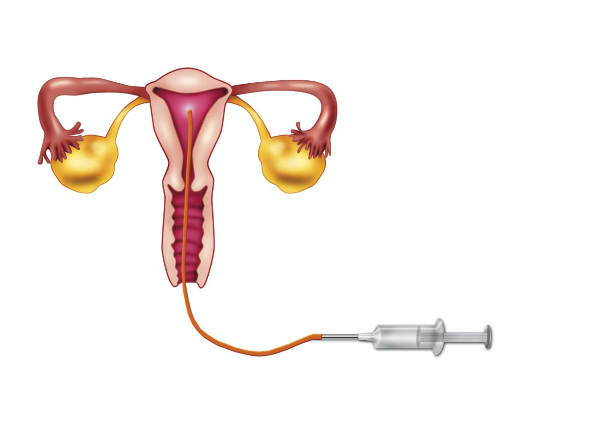 inseminação Intrauterina